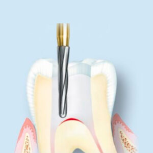 Perché i denti devitalizzati si rompono spesso e come evitarlo