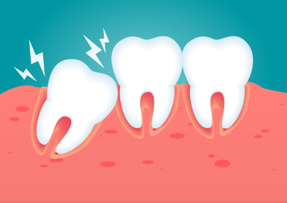 Denti storti: cause, caratteristiche, rischi e rimedi